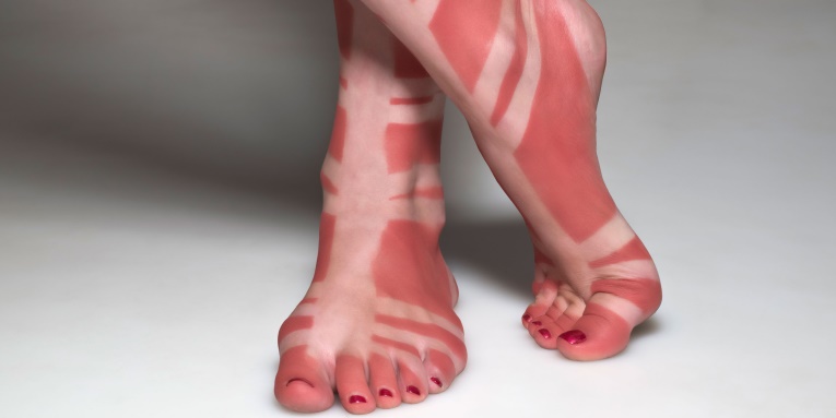 image of sunburn and white sandal straps on skin of feet and ankles